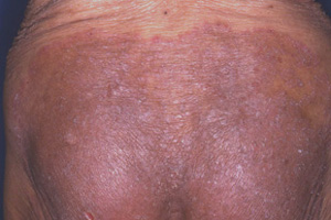 いびきのかゆみはどのくらい続き、伝染力が持続するか