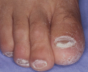 爪白癬 つめはくせん 中島医院 名古屋市千種区の内科 皮膚科 小児科 糖尿病 甲状腺治療